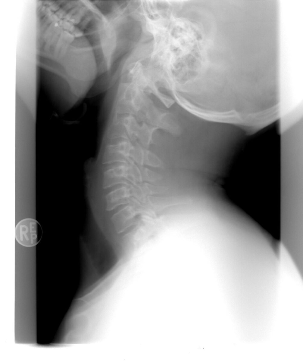 xray, cervical spine, healthcare, injury, gray healthcare, xray, xray, xray, xray, xray, cervical spine